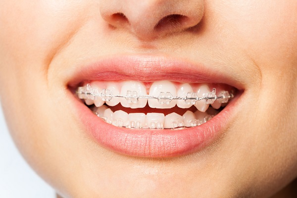 What To Know About Ceramic Braces For Teeth Straightening