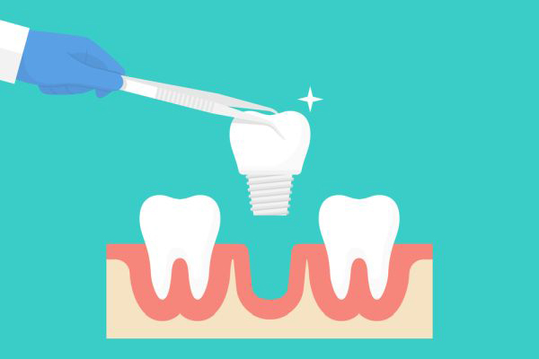 A Dental Implant Can Replace A Missing Tooth And Its Root