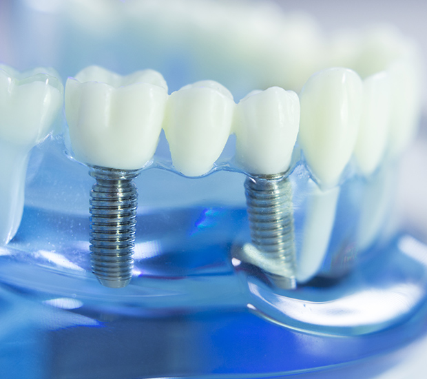 Moreno Valley Dental Implants