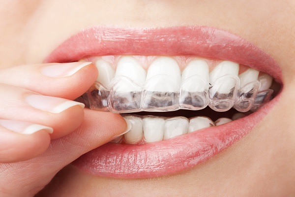 Introduction To Invisalign For Teeth Straightening