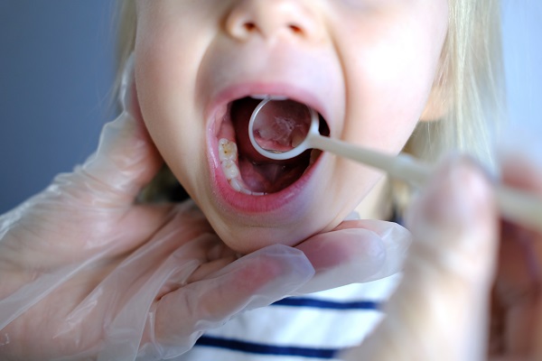 Types Of Dental Fillings For Kids Offered By A Kid Friendly Dentist In Moreno Valley